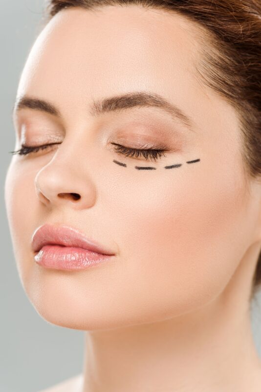 Schema delle aree oculari trattate durante la blefaroplastica per eliminare eccesso di pelle e borse sotto gli occhi.