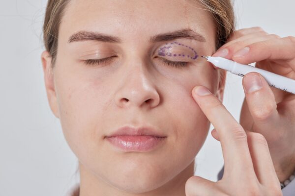 guardo ringiovanito dopo blefaroplastica estetica a Milano presso Vultum Clinic. Elimina palpebre cadenti e borse dagli occhi.